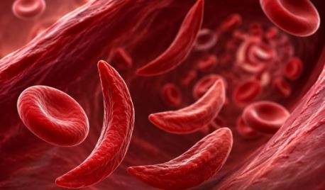 immagine sull'anemia falciforme generata con intelligenza artificiale